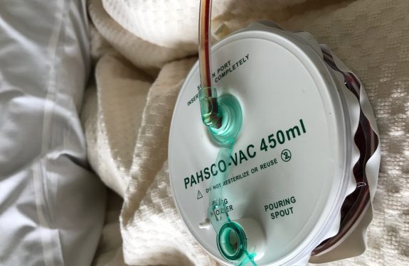 fibroid removal surgery blood drain